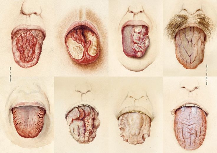 書中關於「舌頭疾病」的醫學插圖。
